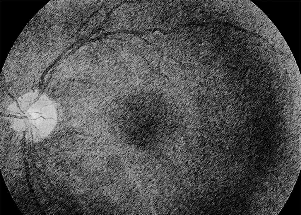 Diabetic glaucoma