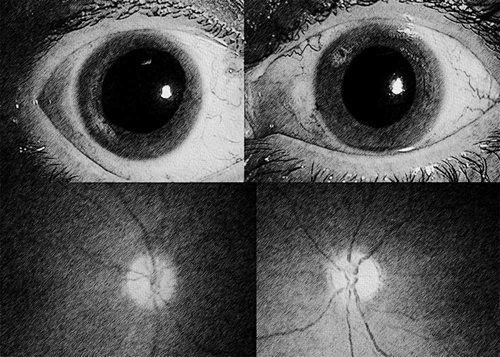 Diabetic neuro-ophthalmopathy