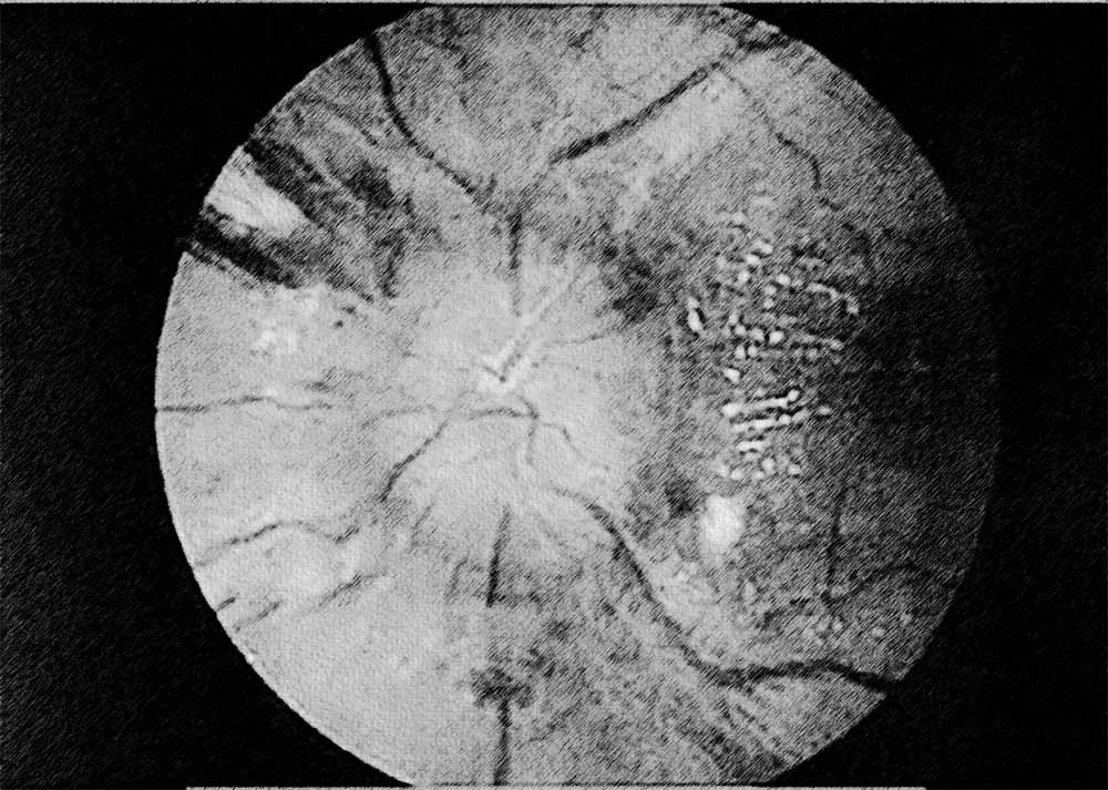 Diabetic neuroophthalmopathy (2) Diabetic neuro-ophthalmopathy