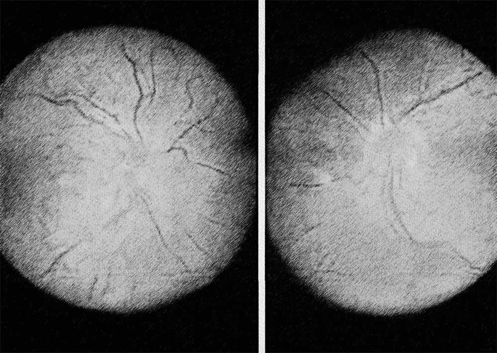 Diabetic neuro-ophthalmopathy