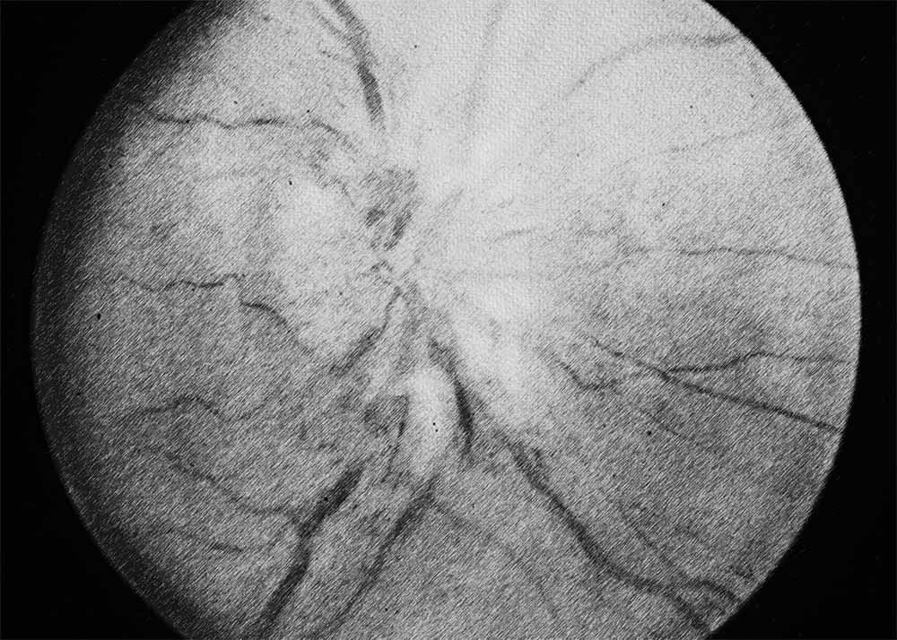 Diabetic papillopathy