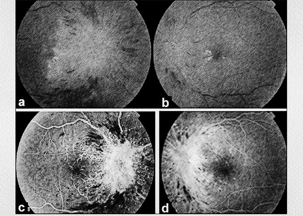 Diabetic papillopathy