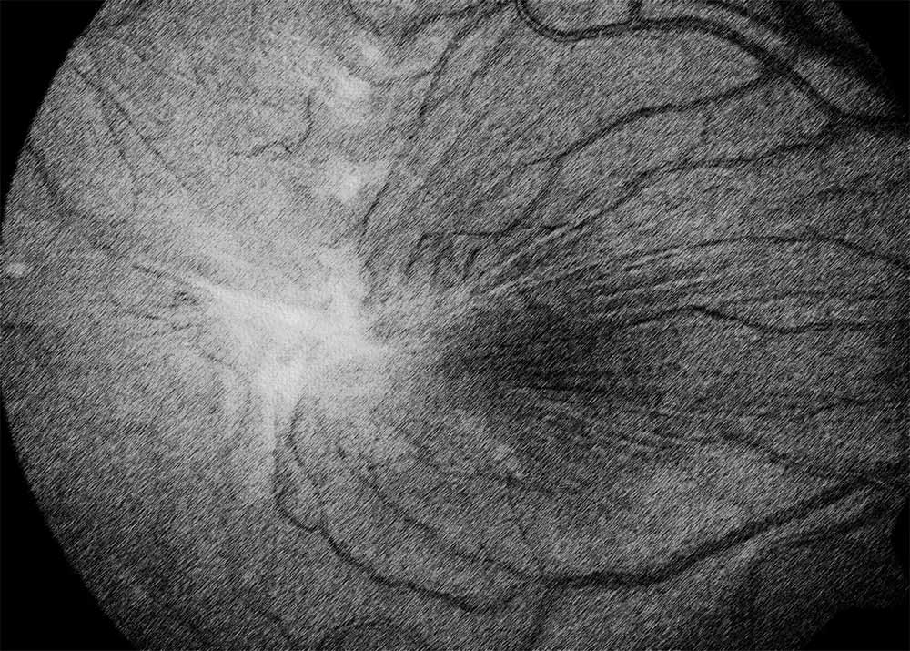 Epiretinal Membrane (ERM)