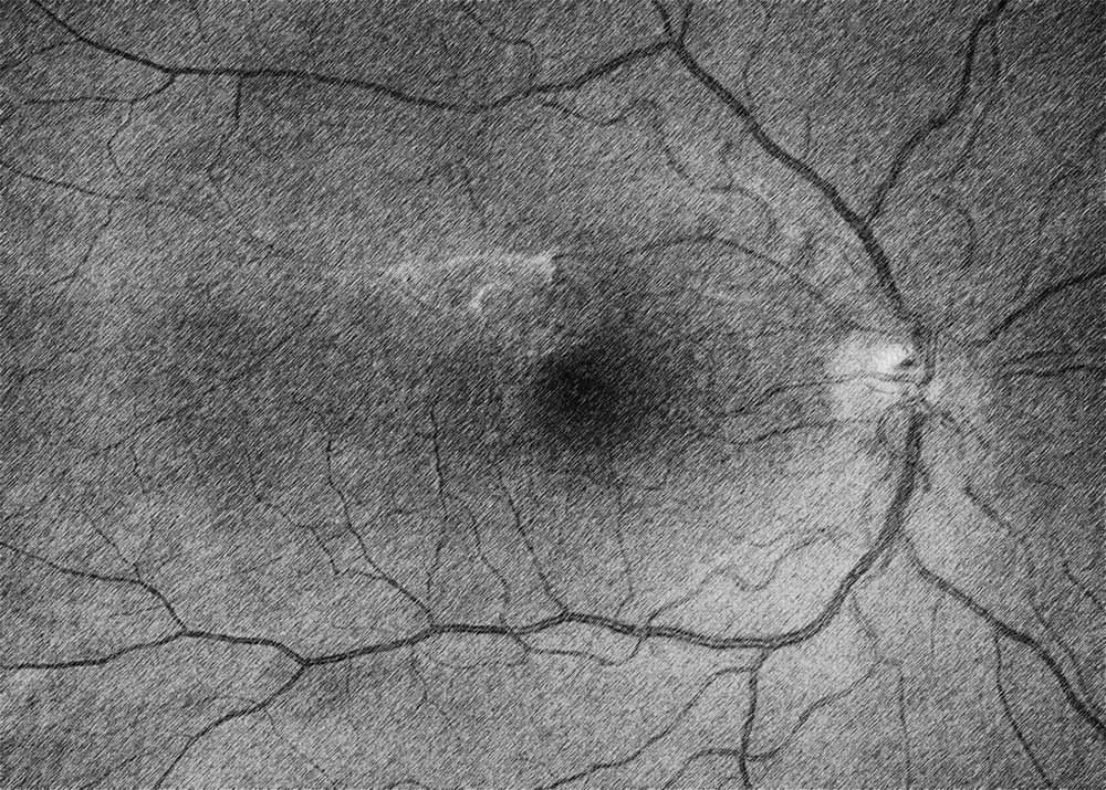 Epiretinal Membrane (ERM)