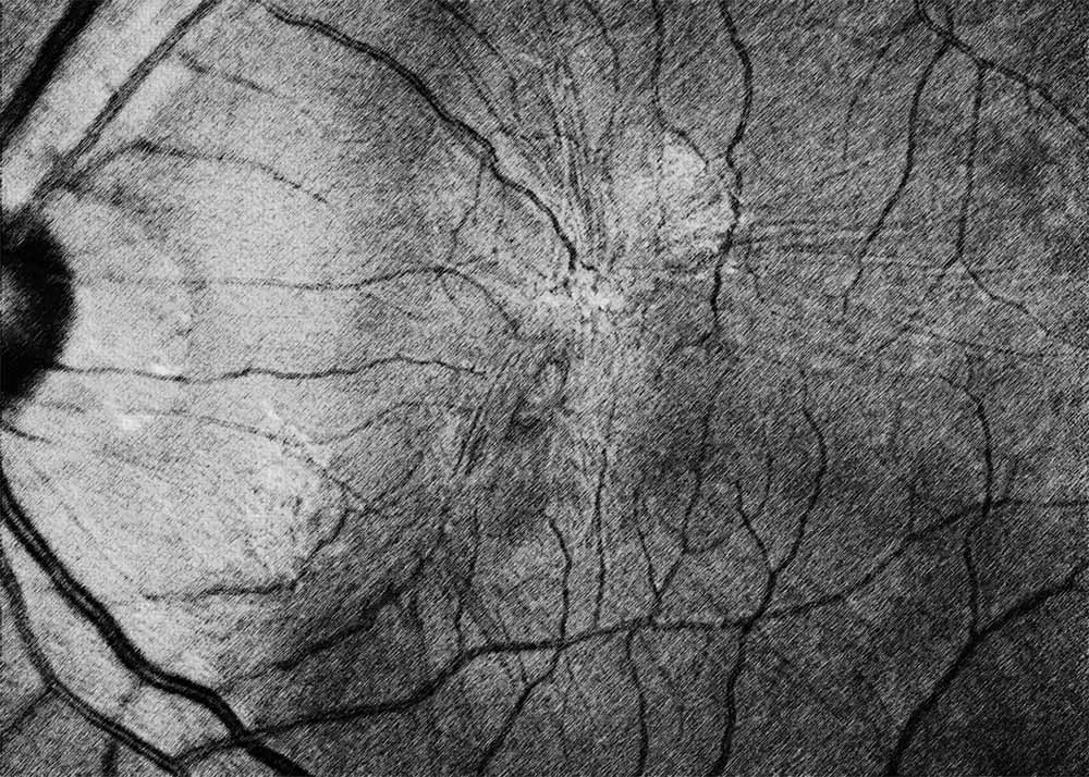 Epiretinal Membrane (ERM)