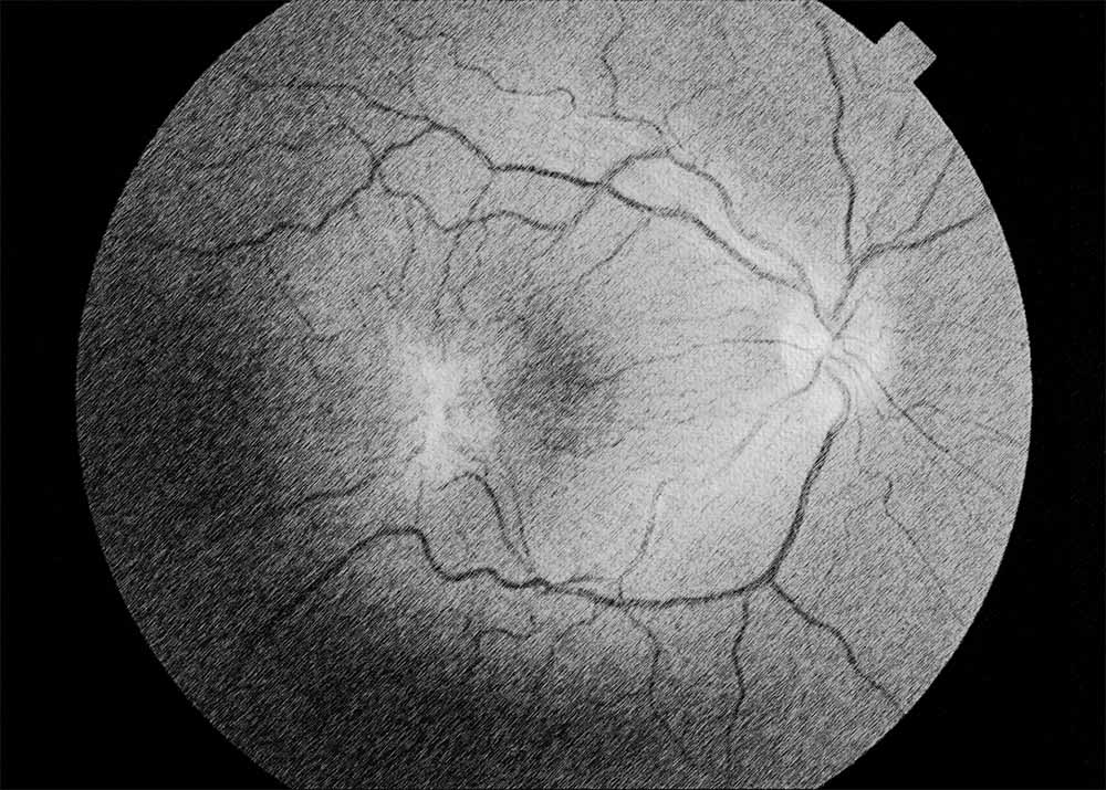 Epiretinal Membrane (ERM)