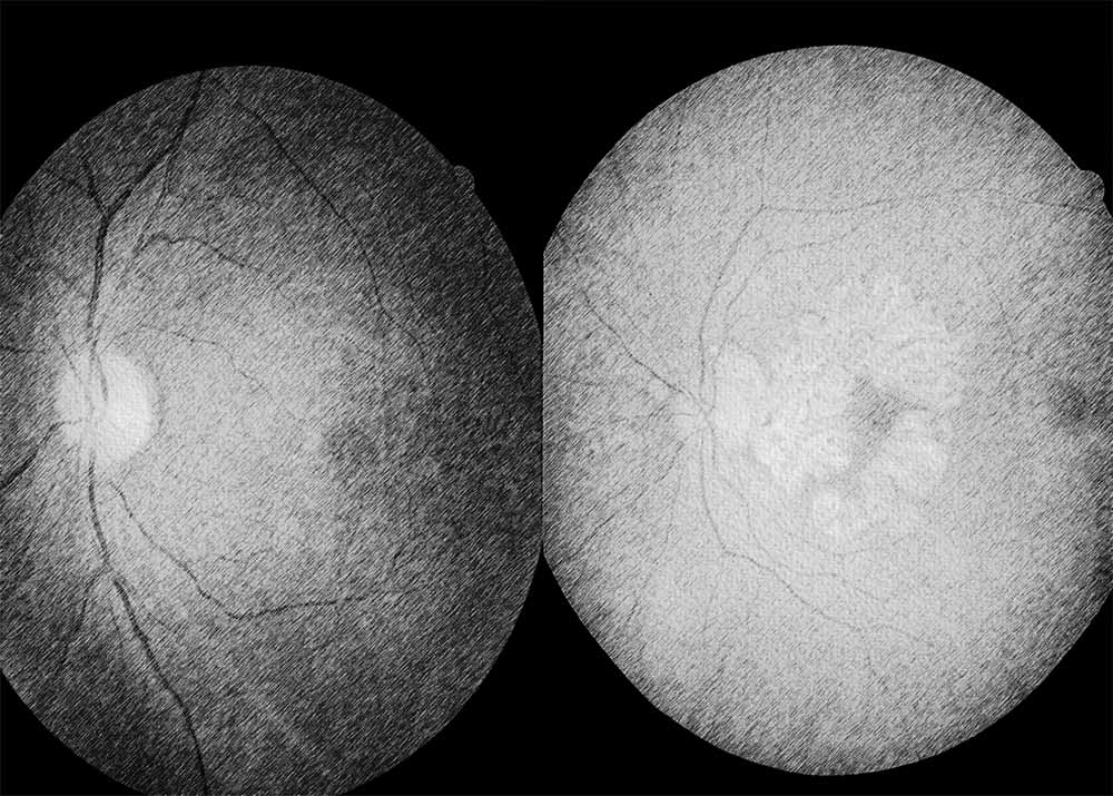 Geographic atrophy (also known as dry AMD)