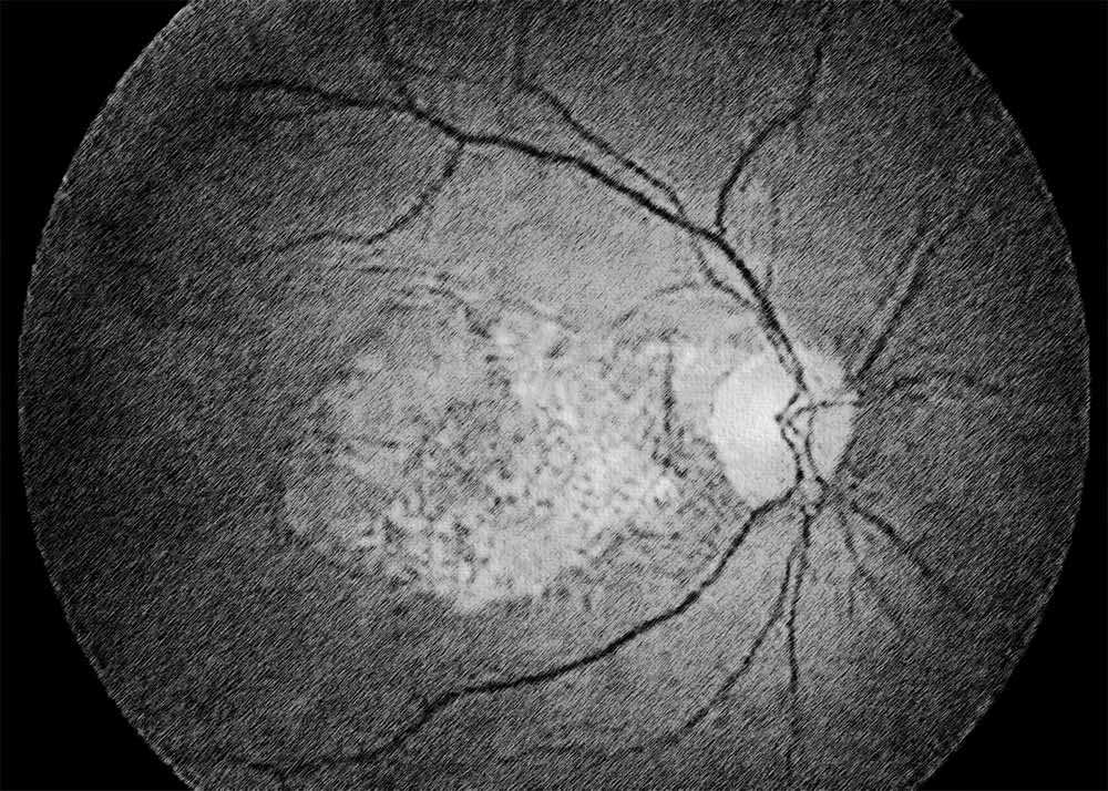 Geographic atrophy (also known as dry AMD) (2) Geographic atrophy (also known as dry AMD)