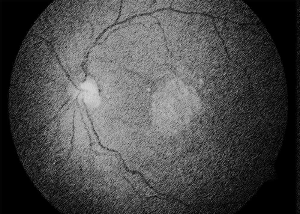 Geographic atrophy (also known as dry AMD)