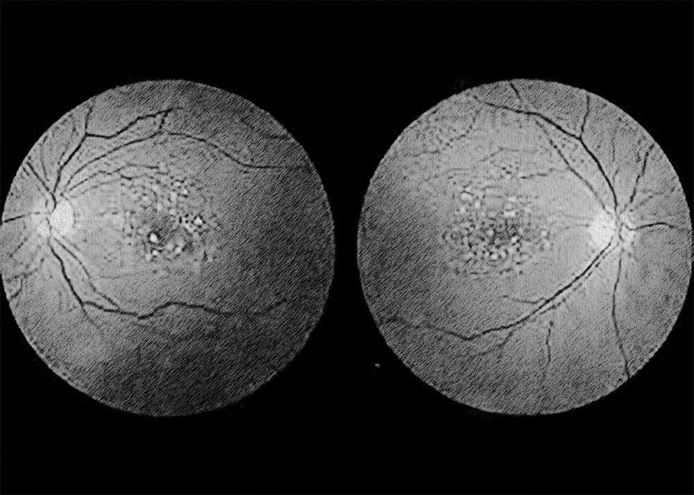 Geographic atrophy (also known as dry AMD) (4) Geographic atrophy (also known as dry AMD)