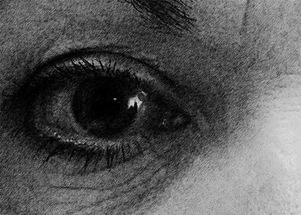 Glaucoma (3) Glaucoma