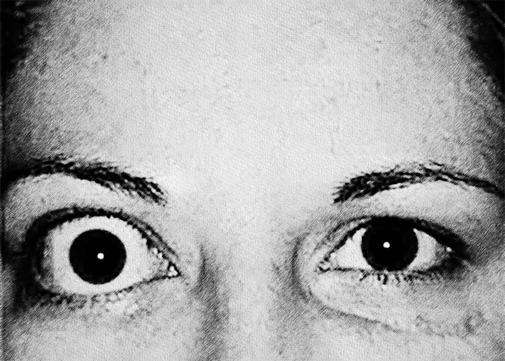 Graves Eye Disease (1) Graves Eye Disease