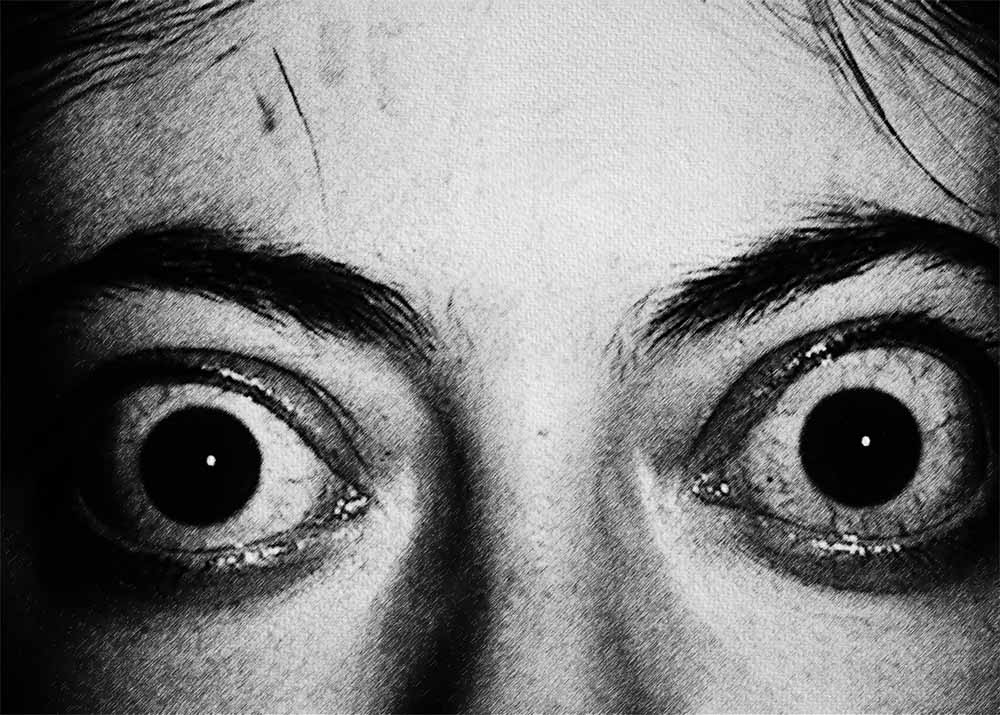 Graves Eye Disease (2) Graves Eye Disease