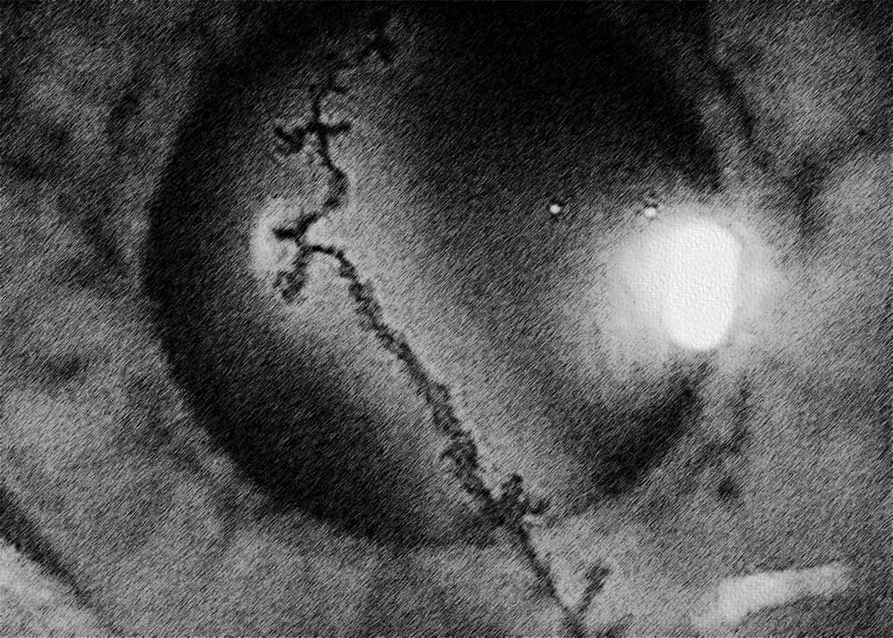 Herpes Simplex Keratitis