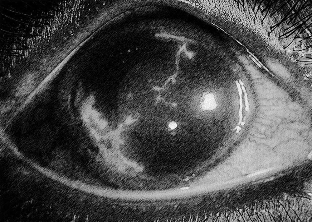 Herpes Simplex Keratitis (2) Herpes Simplex Keratitis