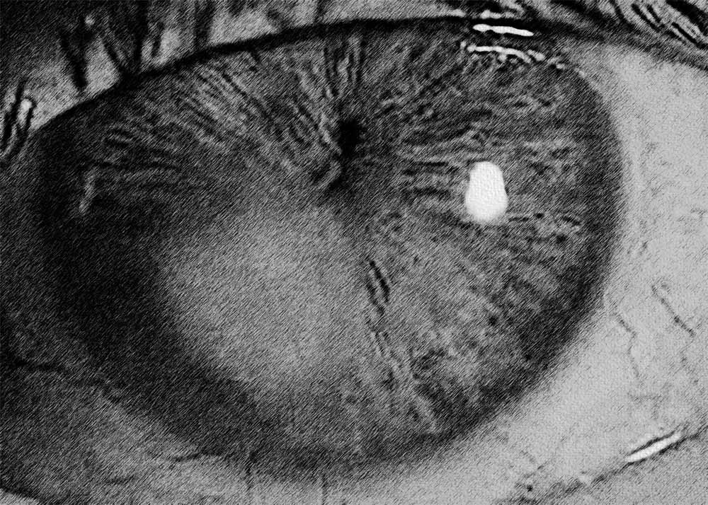 Herpes Zoster Ophthalmicus (4) Herpes Zoster Ophthalmicus