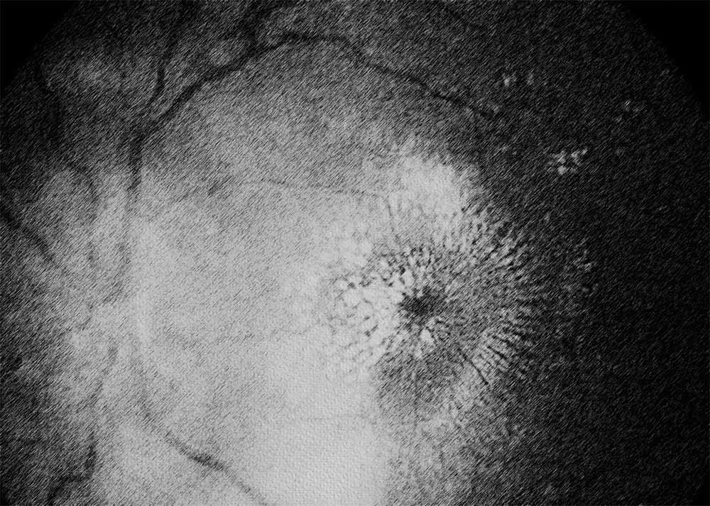 Hypertensive Retinopathy (3) Eye Cancer