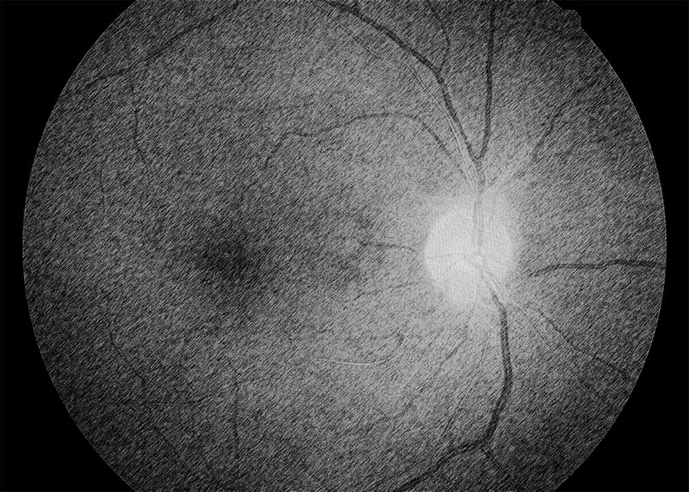 Hypertensive Retinopathy (4) Eye Cancer