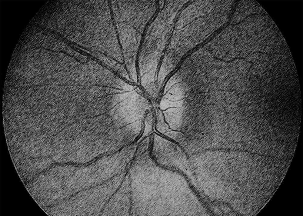 Idiopathic Intracranial Hypertension