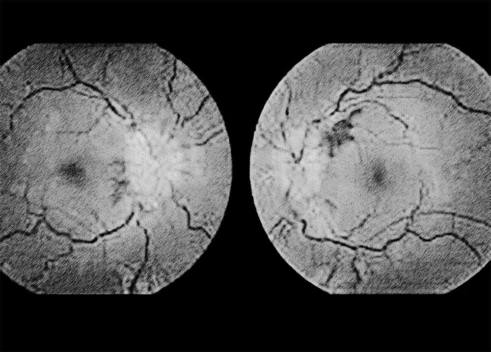 Idiopathic Intracranial Hypertension (2) Idiopathic Intracranial Hypertension
