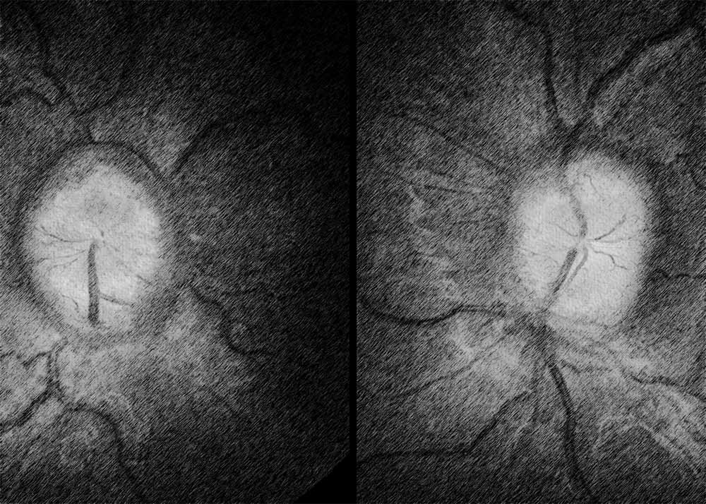 Idiopathic Intracranial Hypertension (3) Idiopathic Intracranial Hypertension