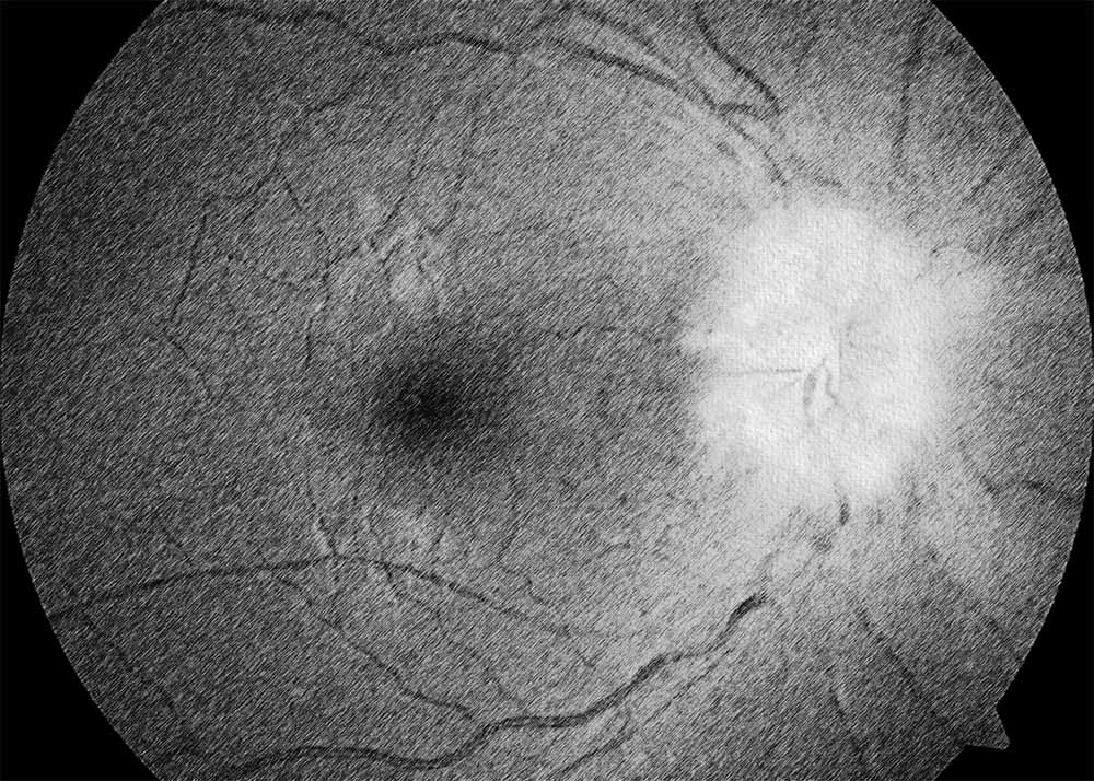 Idiopathic Intracranial Hypertension (4) Idiopathic Intracranial Hypertension