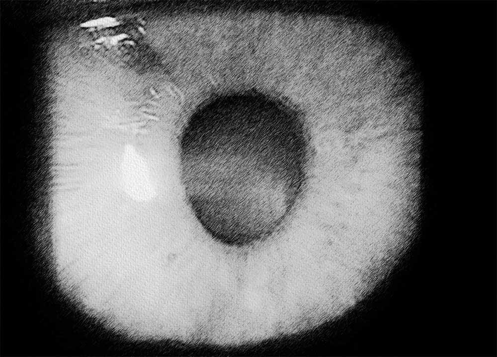Iridocorneal endothelial syndrome (ICE) (2) Iridocorneal endothelial syndrome (ICE)