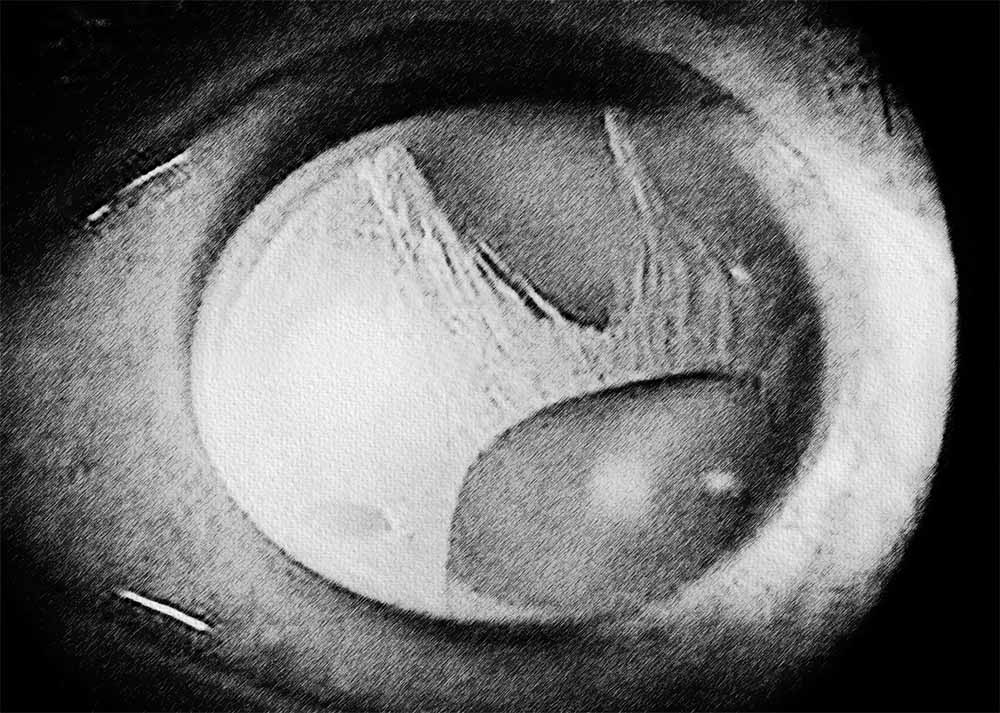 Iridocorneal endothelial syndrome (ICE)