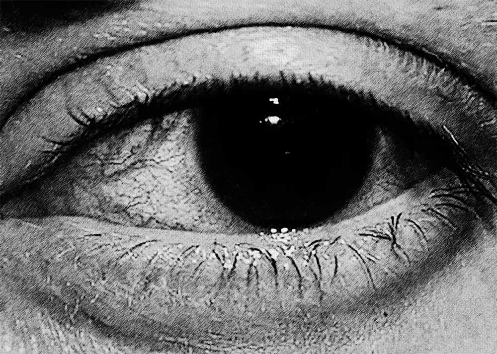 Keratitis (3) Keratitis