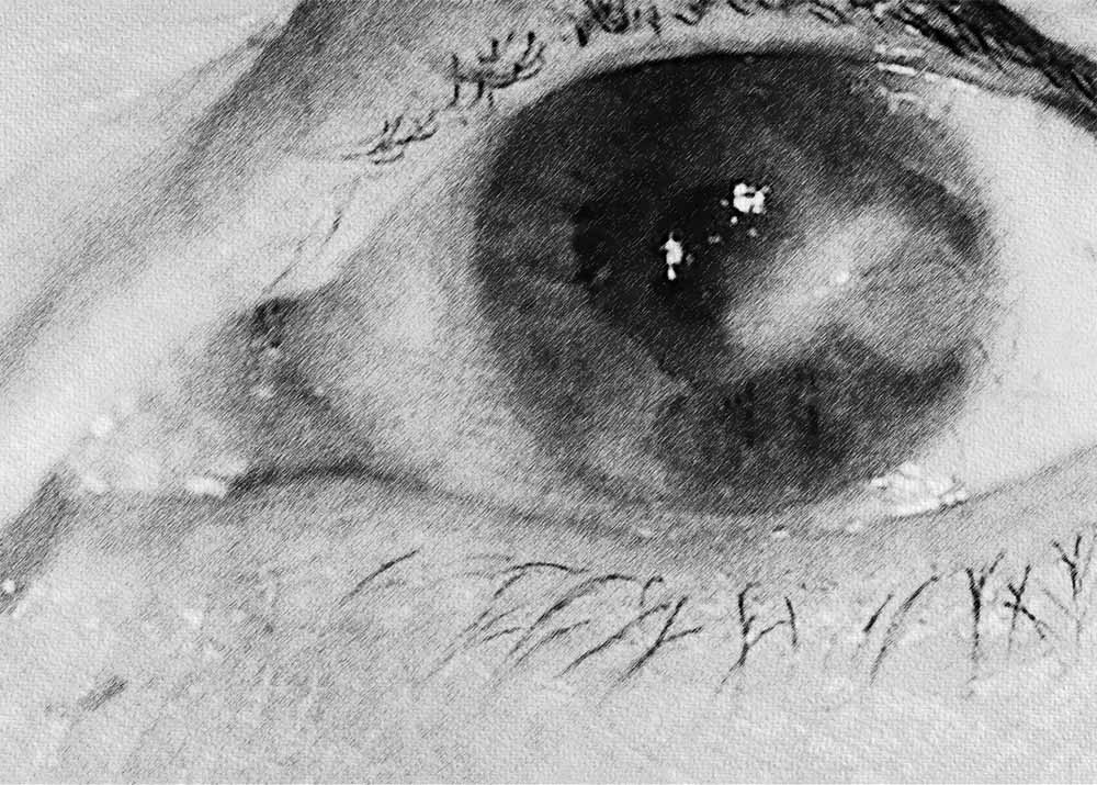 Keratitis (4) Keratitis