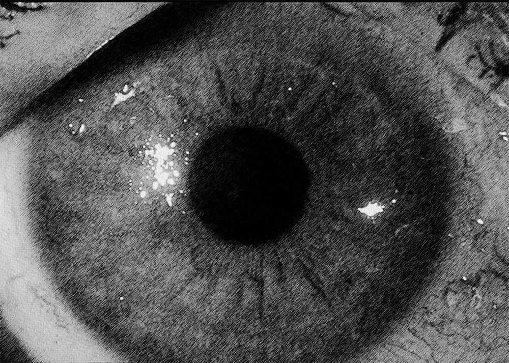 Keratoconjunctivitis Sicca (KCS) (1) Keratoconjunctivitis Sicca