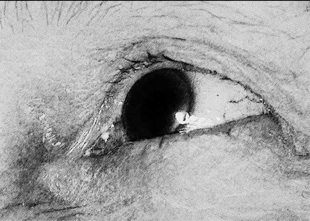 Keratoconjunctivitis Sicca