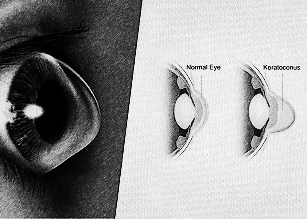 Keratoconus (2) Keratoconus