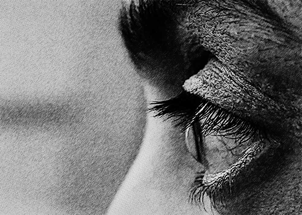 Keratoconus (4) Keratoconus