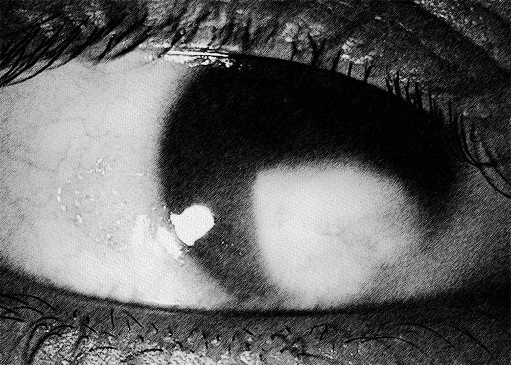 Keratomalacia (2) Keratomalacia