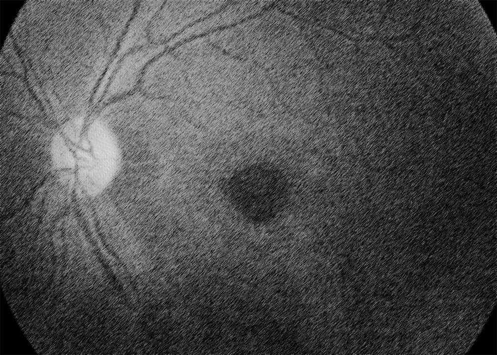 Macular Hole (1) Macular hole