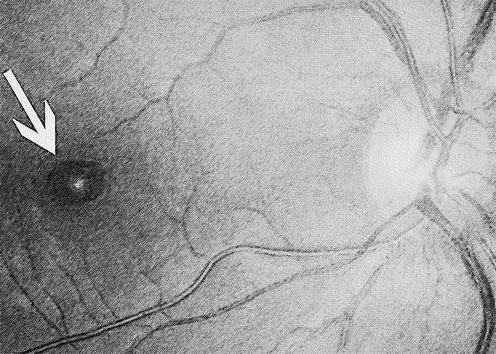 Macular hole