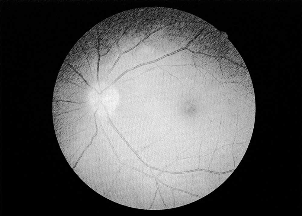 Macular Hole (3) Macular hole
