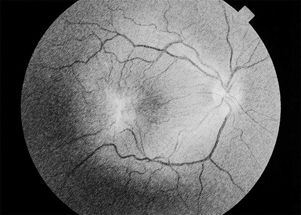 Macular Pucker (1) Macular Pucker