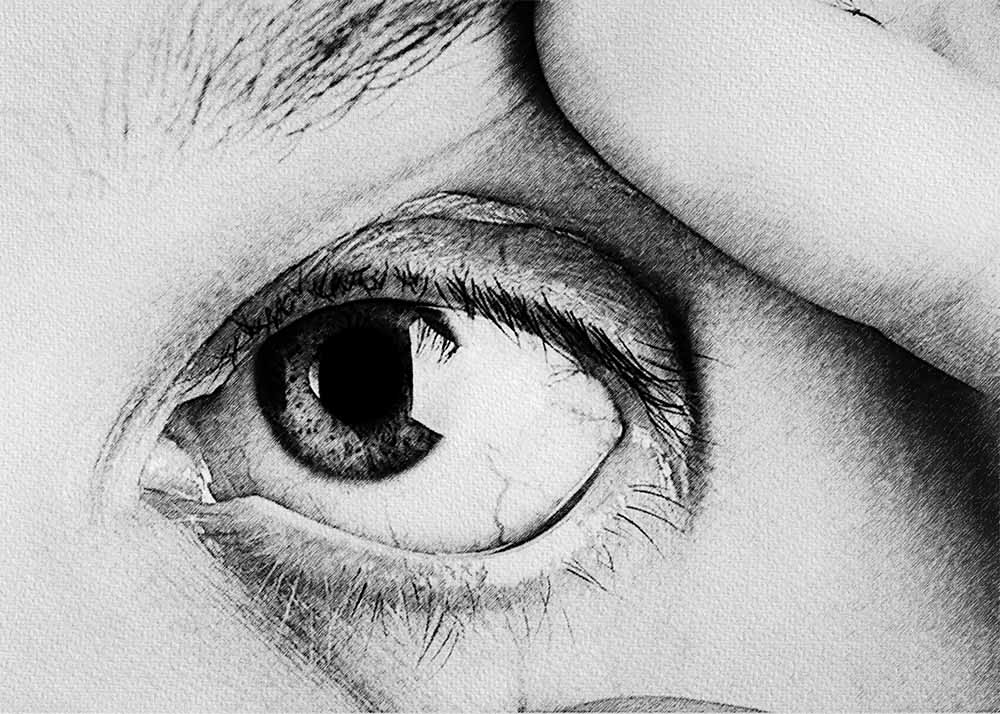 Irritated Eye Macular Pucker