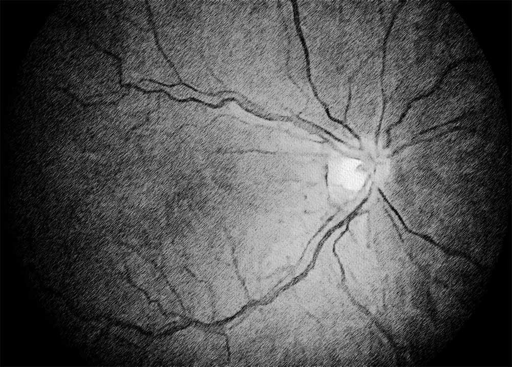Macular Pucker (3) Macular Pucker