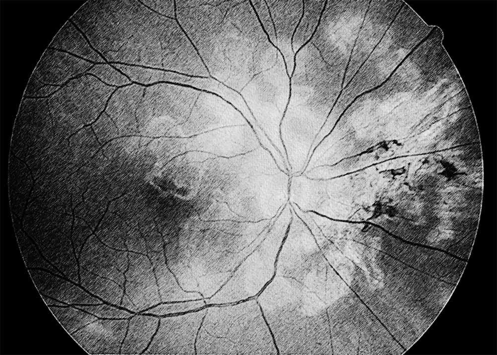 Macular serpiginous choroiditis