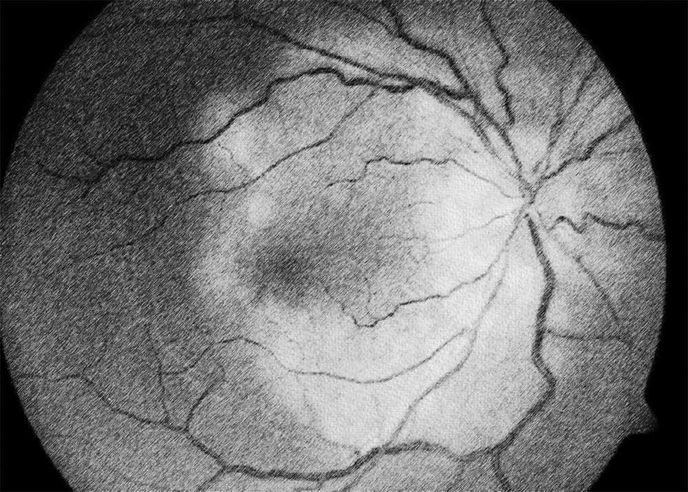 Macular serpiginous choroiditis