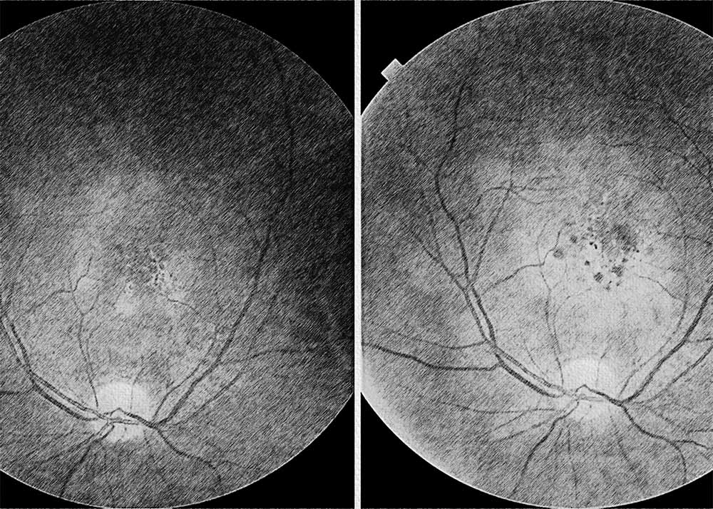 Macular serpiginous choroiditis