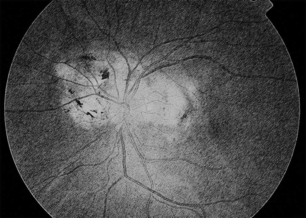 Macular serpiginous choroiditis