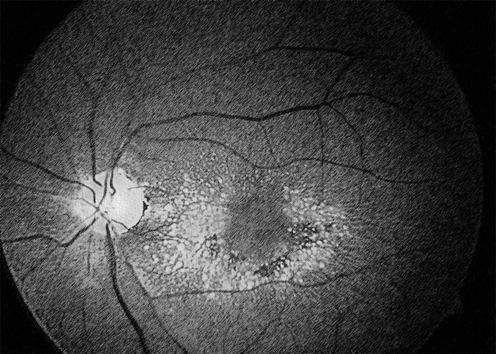 Malattia Leventinese (Doyne honeycomb retinal dystrophy)