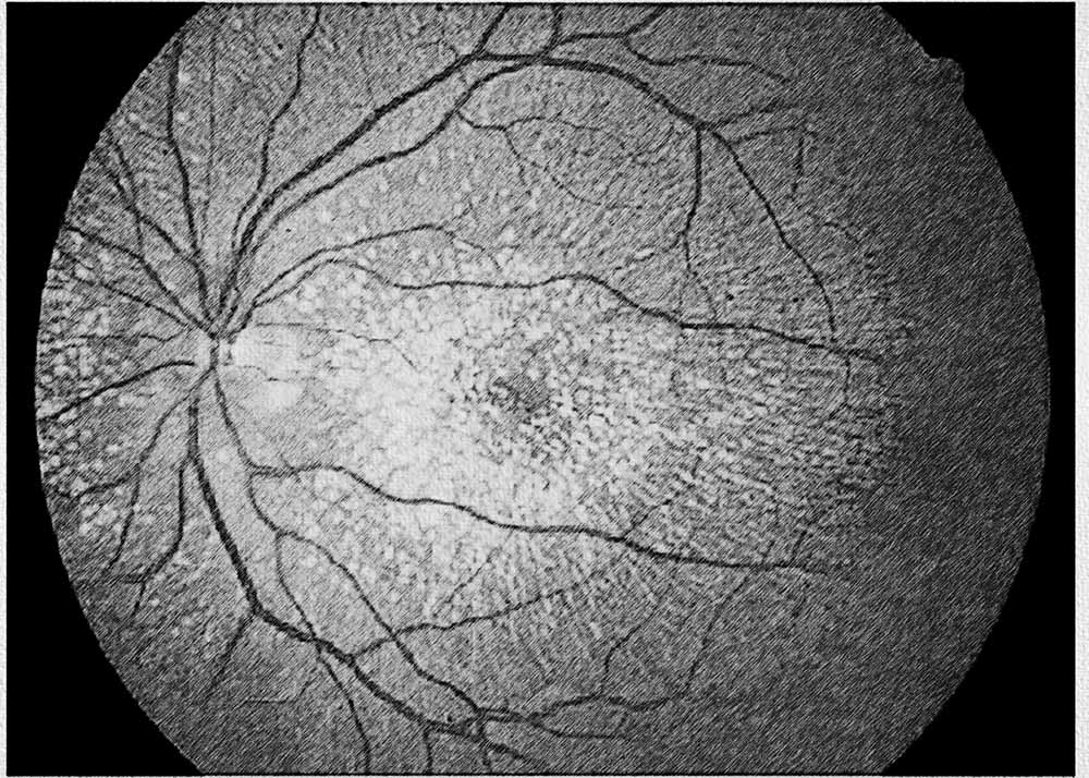 Malattia Leventinese (Doyne honeycomb retinal dystrophy)