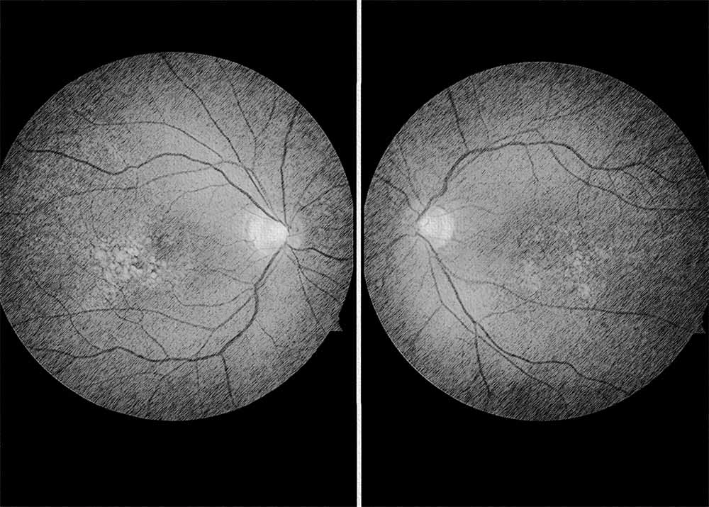 Malattia Leventinese (Doyne honeycomb retinal dystrophy) (4) Malattia Leventinese (Doyne honeycomb retinal dystrophy)