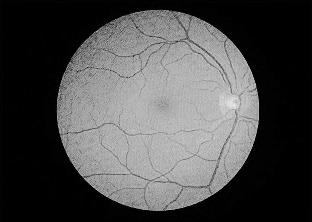 Myopic Macular Degeneration