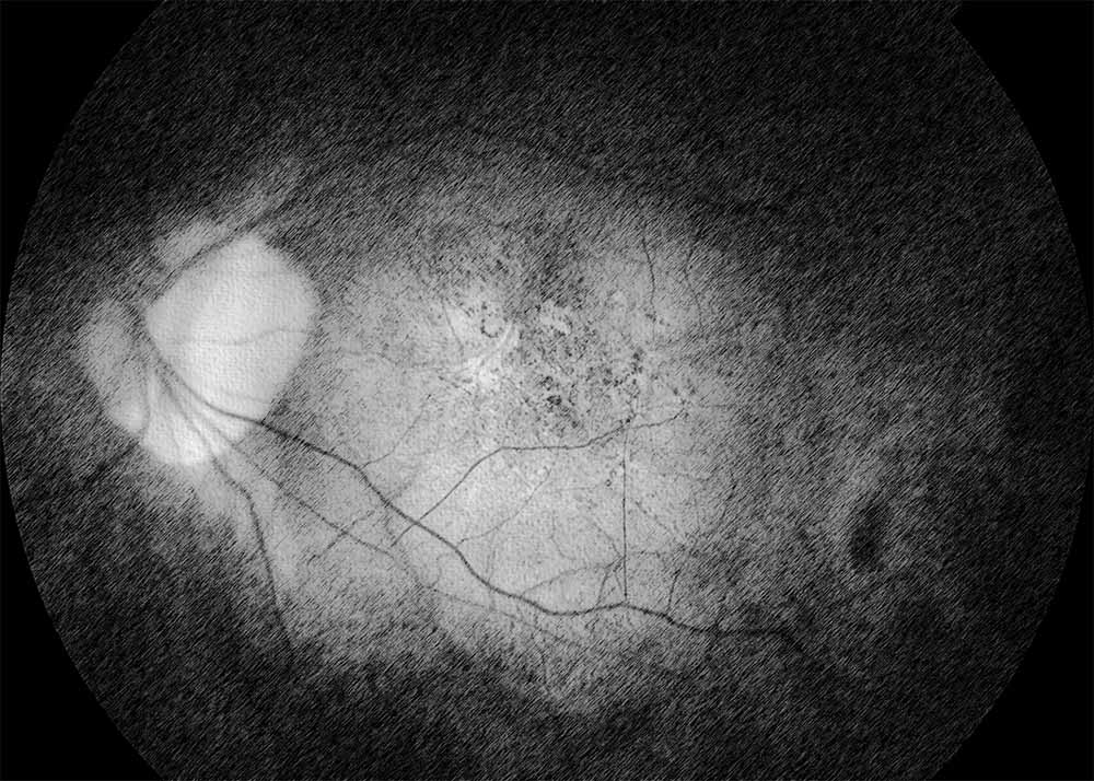 Myopic Macular Degeneration